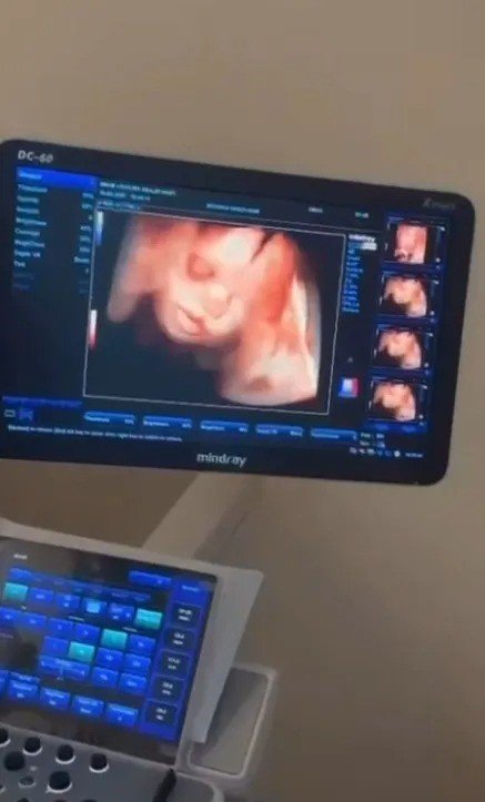 sinop-ataturk-devlet-hastanesine-4-boyutlu-ultrason-cihazi