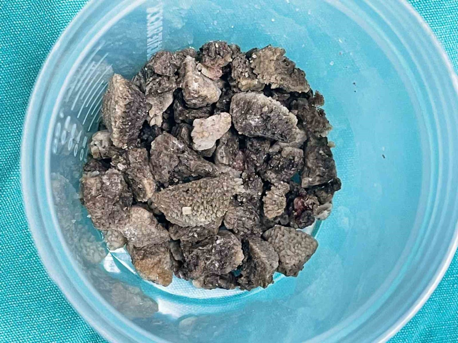 8-santimetrelik-geyik-boynuzu-bobrek-tasi-kapali-yontemle-cikarildi