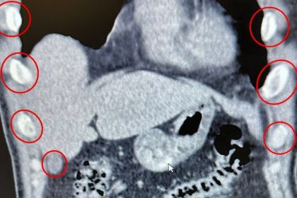 midelerinden-136-kapsul-uyusturucu-cikti