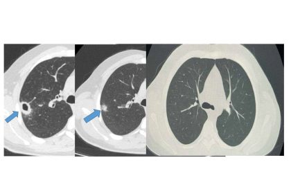 bayburtta-50-yasindaki-hasta-erken-taniyla-sagligina-kavustu