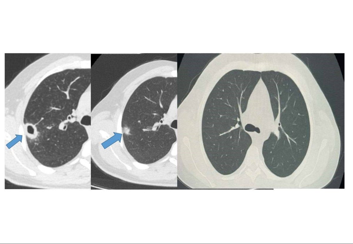 bayburtta-50-yasindaki-hasta-erken-taniyla-sagligina-kavustu