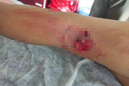 okula-giderken-sokak-kopeginin-saldirisina-ugradi