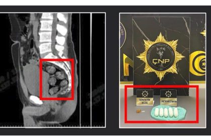 tomografide-sok-eden-goruntu-uyusturucu-midesinden-cikarildi