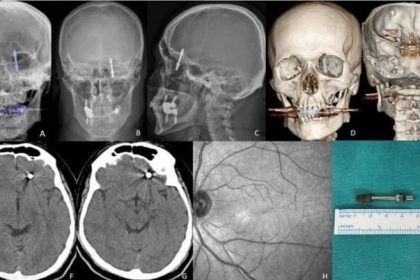 beynine-saplanan-implant-hayatini-karartti-2-yildir-adalet-bekliyor