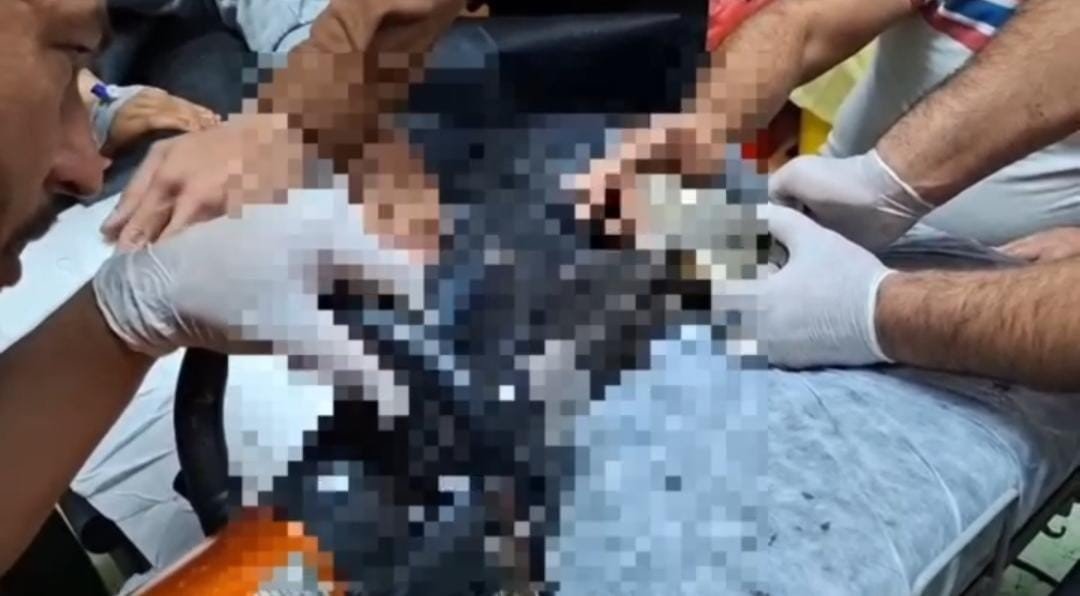 tel-abyadta-elini-kiyma-makinesine-kaptiran-cocuk-sanliurfada-tedavi-altina-alindi