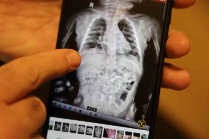 dogustan-200-binde-bir-gorulen-hastalikla-2-yil-boyunca-yasayan-cocuk-sagligina-kavustu