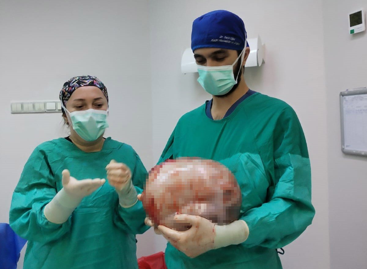 karni-2-ayda-9-aylik-hamile-gibi-buyuyen-kadinin-icinden-karpuz-kadar-kitle-cikarildi