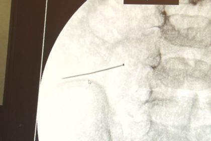 agriyla-kivranan-2-yasindaki-cocugun-bagirsagindan-3-santimlik-igne-cikti