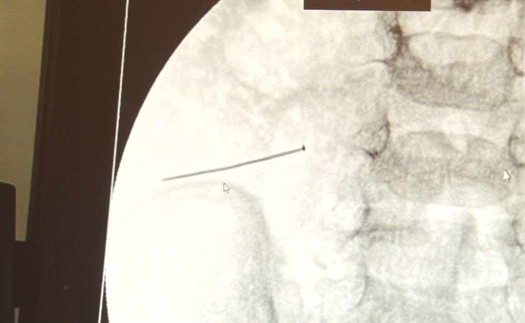 agriyla-kivranan-2-yasindaki-cocugun-bagirsagindan-3-santimlik-igne-cikti